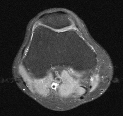 knee mri scan cross section